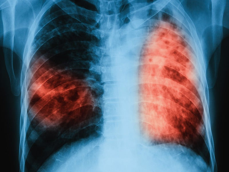 «Έξυπνο» σύστημα κάνει διαγνώσεις φυματίωσης